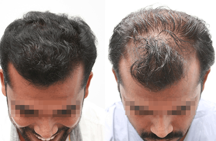 3 Best Hair Transplant Surgeons in Visakhapatnam AP  ThreeBestRated